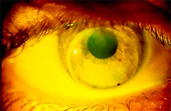 Diagnostic lens applied OD