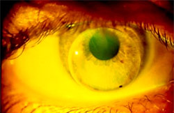 Diagnostic spherical lens OD