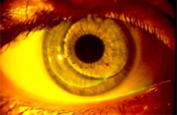 Toric lens on same eye