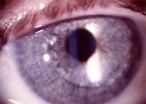 Post-penetrating keratoplasty with running suture