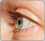 GP lens on eye