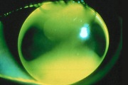 Fluorescein Pattern Identification Guide Gpli